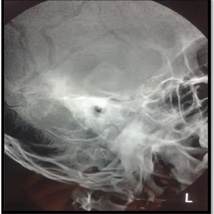 An Interventional Study Of Pars Tensa Retraction Pockets A Comparison Between Grommet Insertion And Medical Management