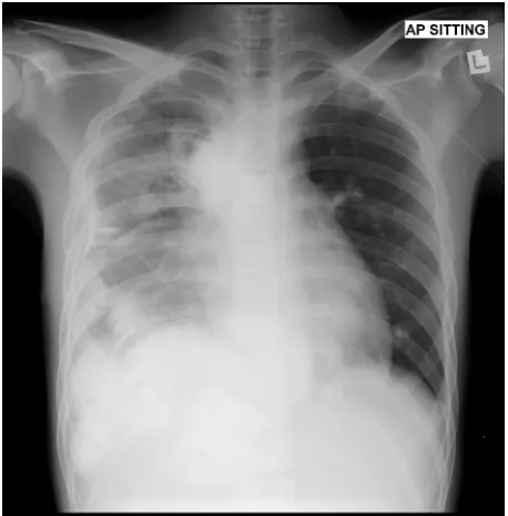 Single Photon Emission Computed Tomography Computed Tomography Spect Ct Use In Osteosarcoma With Lung Uptake