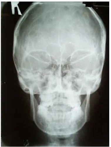 Clinicoradiological Correlation Of Crouzon Syndrome A Case Report P Venkatalakshmi Aparna 1 F Massillamani1 A Priyadharshini 1 And D K S Lakshminrusimhan 1